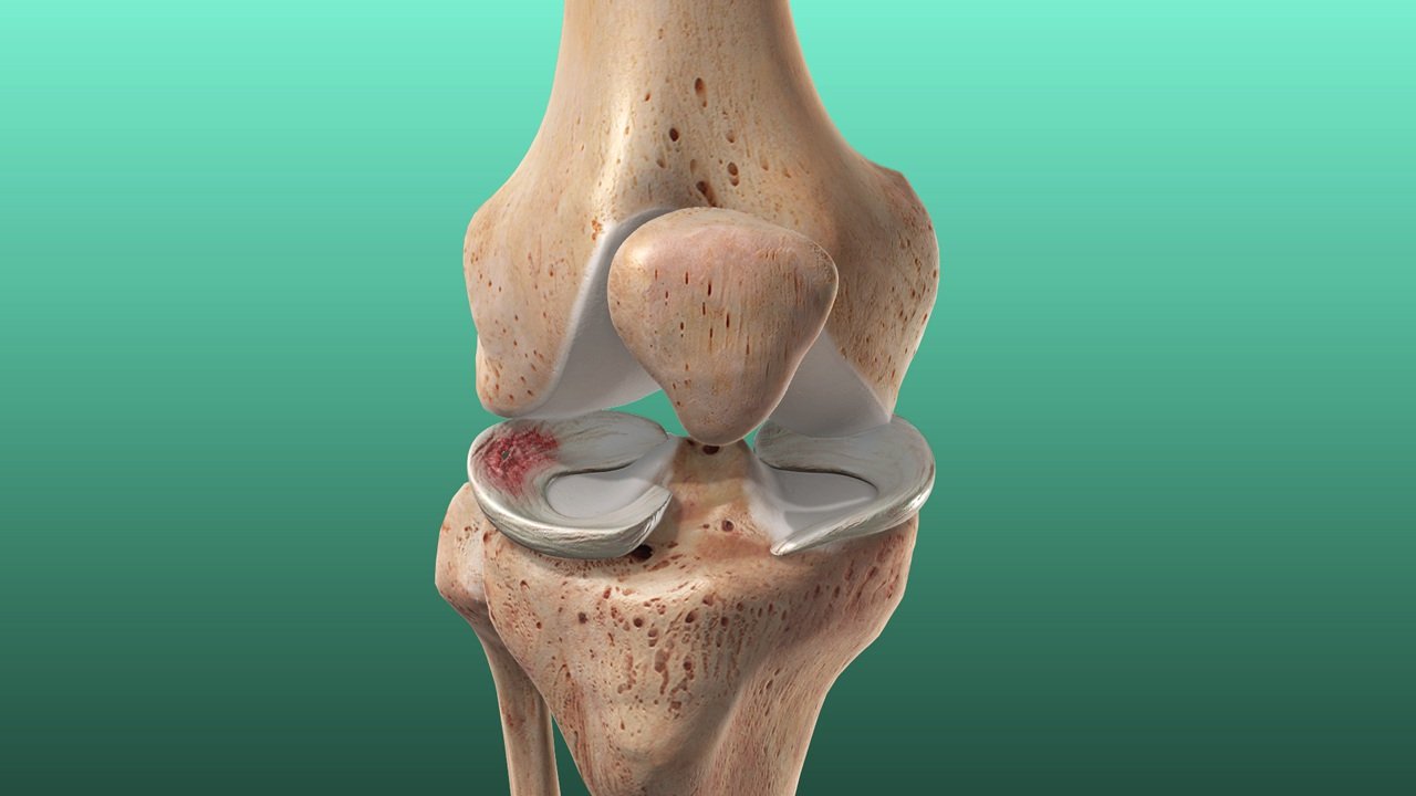 Meniscus Injury Treatment